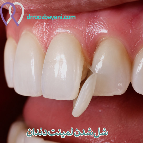 شل شدن لمینت دندان - دکتر روزبیانی