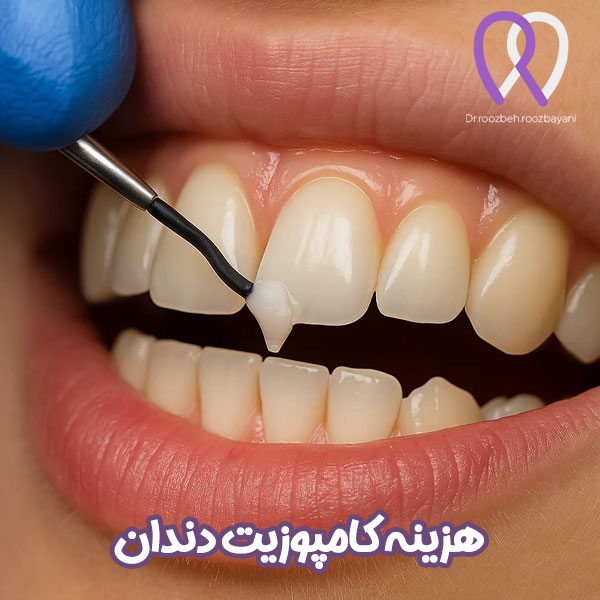 هزینه کامپوزیت دندان