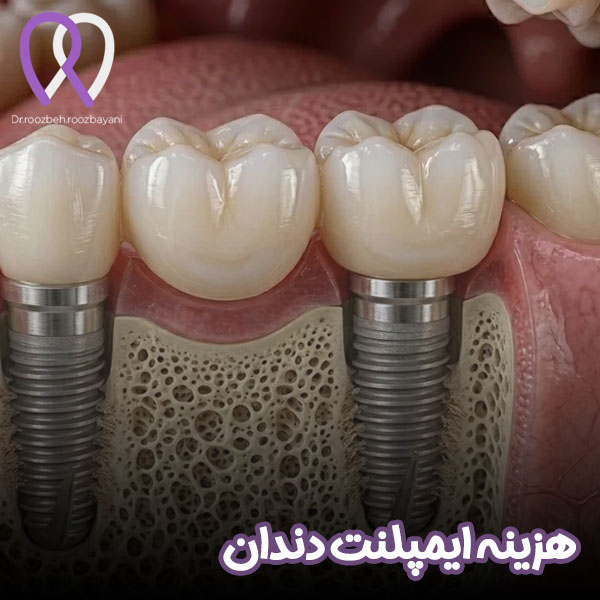 هزینه ایمپلنت دندان